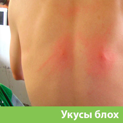 Укусы блох в Ставрополе