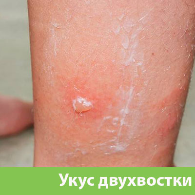 Укус двухвостки в Ставрополе