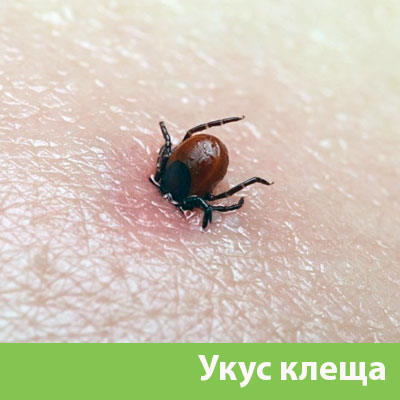 Укус клеща в Ставрополе