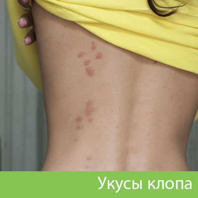 Профессиональное уничтожение клопов в Ставрополе